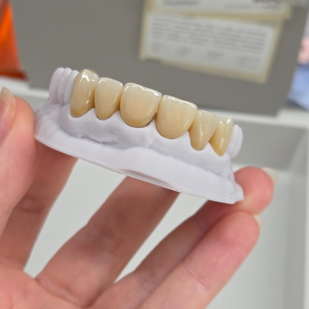 Ukázka zubní náhrady (keramické fazety a korunky) z dentální laboratoře virtuoss lab