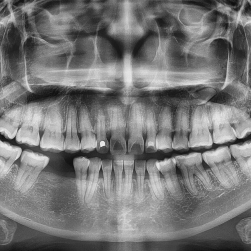 OPG panaromatický rentgen stomatologie