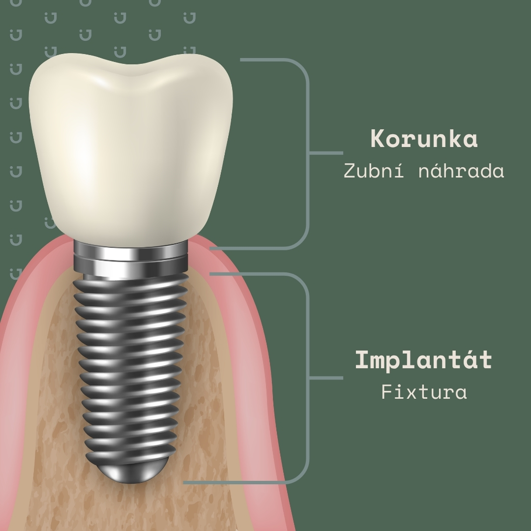 Zubní implantát části vysvětlení co to je. Korunka na implantátu.