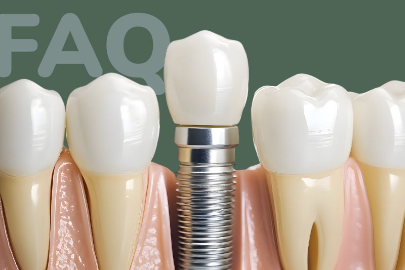 co je zubní implantát implantáty praha vinohrady zubař stomatologie faq